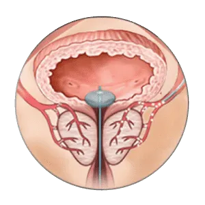 embolisation prostatique paris la technique d'embolisation de la prostate
