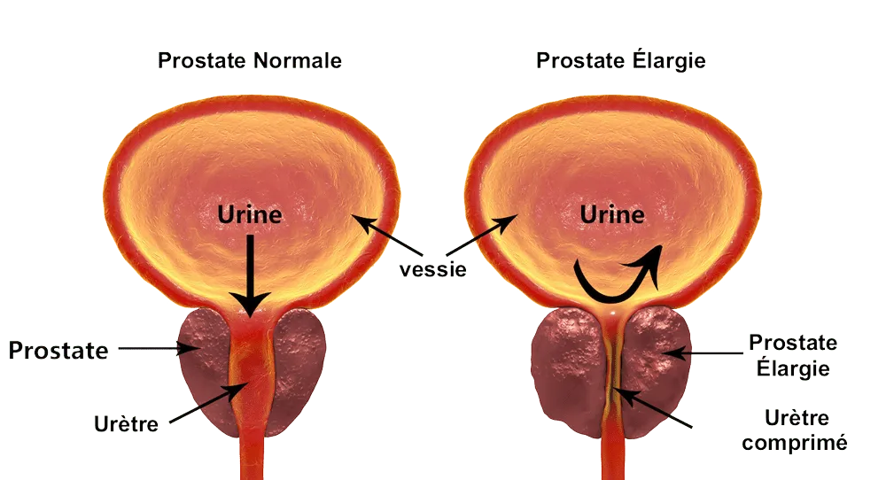 adenome de prostate Adenome de la prostate