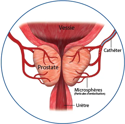 embolisation prostate Embolisation de la prostate
